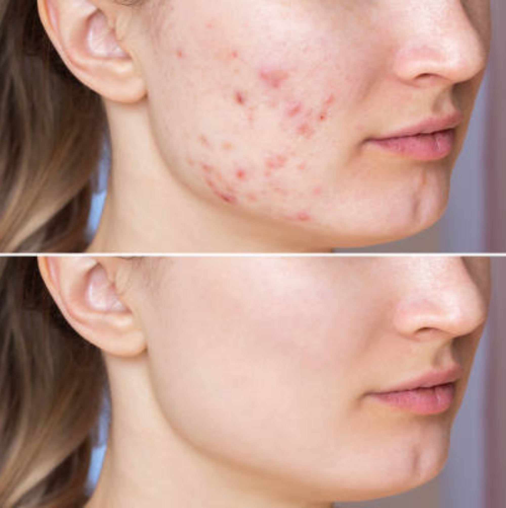 Before and after images showcasing clear skin results from the Acne Care Box.